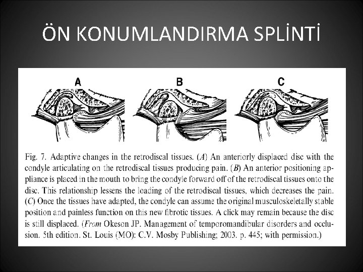 ÖN KONUMLANDIRMA SPLİNTİ 