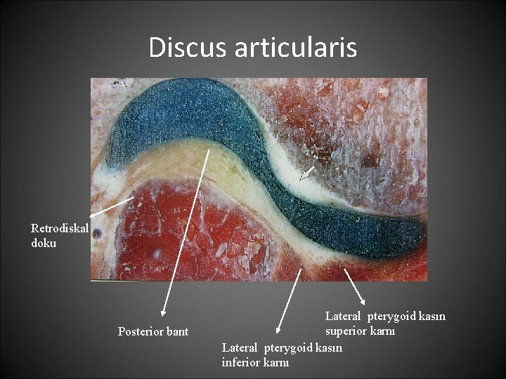 Discus articularis Retrodiskal doku Posterior bant Lateral pterygoid kasın superior karnı Lateral pterygoid kasın