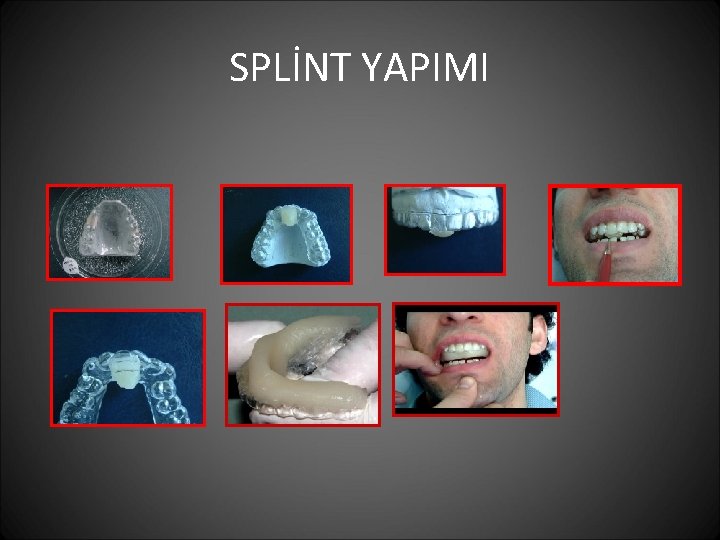 SPLİNT YAPIMI 