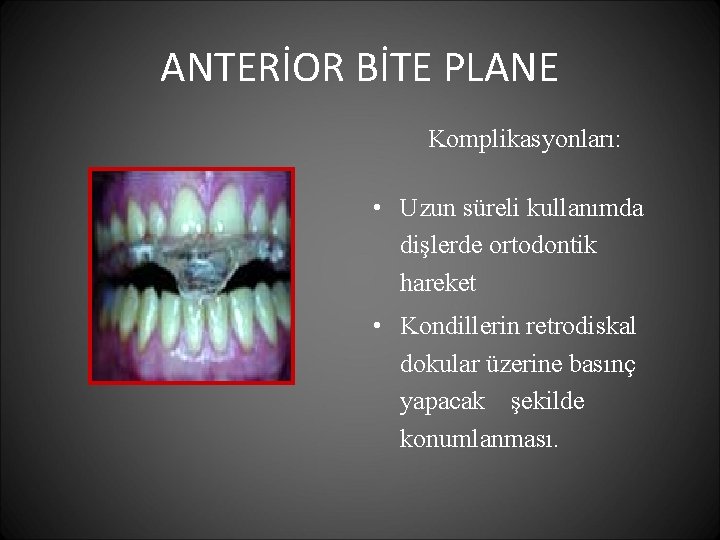 ANTERİOR BİTE PLANE Komplikasyonları: • Uzun süreli kullanımda dişlerde ortodontik hareket • Kondillerin retrodiskal