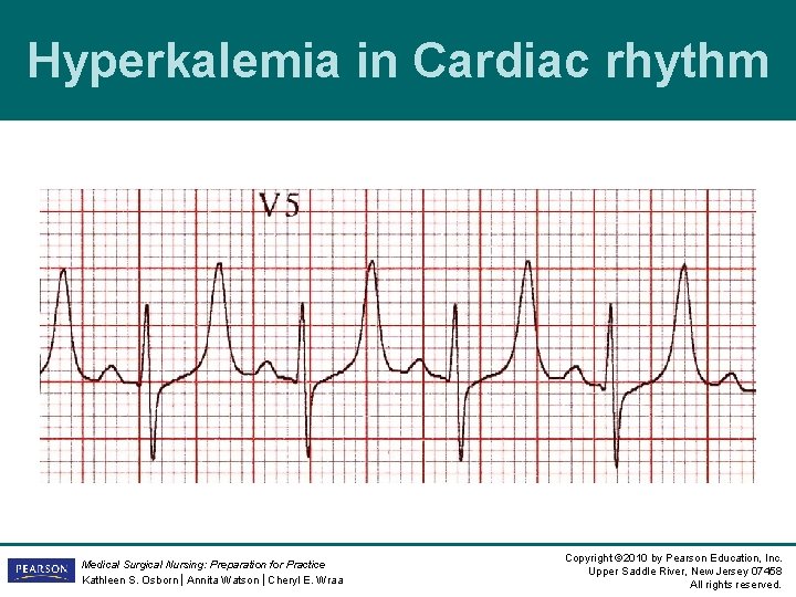 Hyperkalemia in Cardiac rhythm Medical Surgical Nursing: Preparation for Practice Kathleen S. Osborn | Hyperkalemia in Cardiac rhythm Medical Surgical Nursing: Preparation for Practice Kathleen S. Osborn |