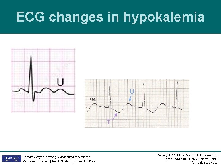 ECG changes in hypokalemia Medical Surgical Nursing: Preparation for Practice Kathleen S. Osborn | ECG changes in hypokalemia Medical Surgical Nursing: Preparation for Practice Kathleen S. Osborn |
