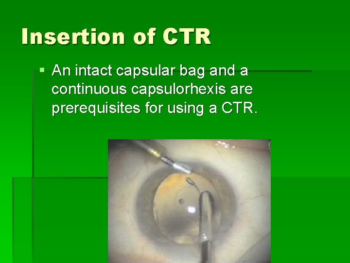 Insertion of CTR § An intact capsular bag and a continuous capsulorhexis are prerequisites