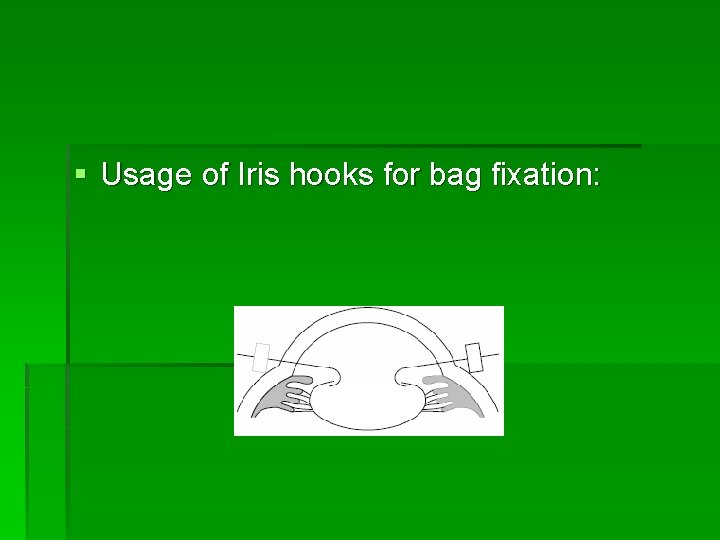 § Usage of Iris hooks for bag fixation: 