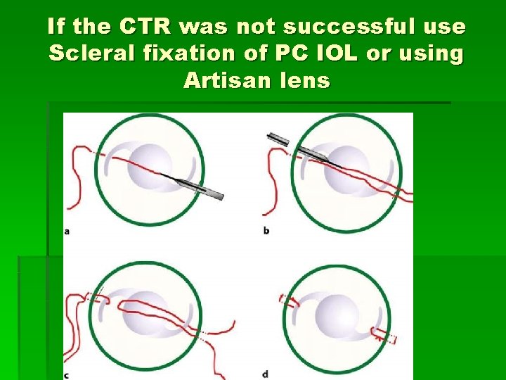 If the CTR was not successful use Scleral fixation of PC IOL or using