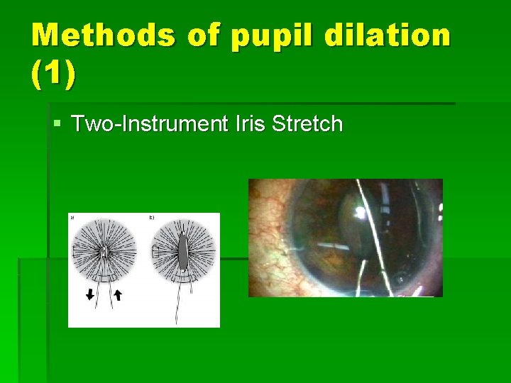 Methods of pupil dilation (1) § Two-Instrument Iris Stretch 