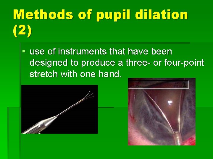 Methods of pupil dilation (2) § use of instruments that have been designed to