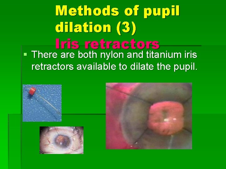 Methods of pupil dilation (3) Iris retractors § There are both nylon and titanium