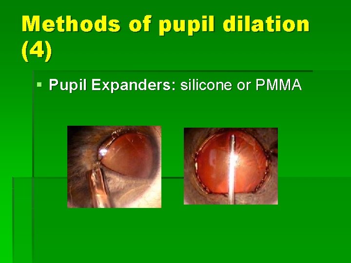 Methods of pupil dilation (4) § Pupil Expanders: silicone or PMMA 