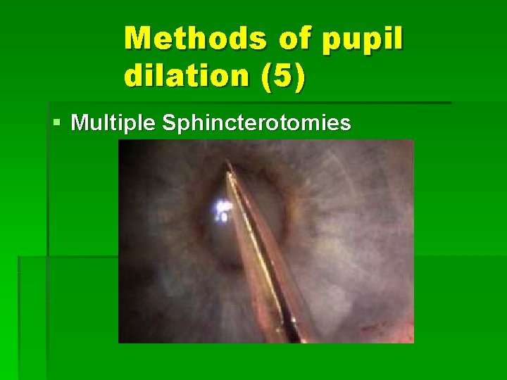 Methods of pupil dilation (5) § Multiple Sphincterotomies 