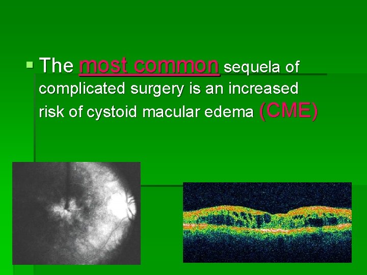 § The most common sequela of complicated surgery is an increased risk of cystoid