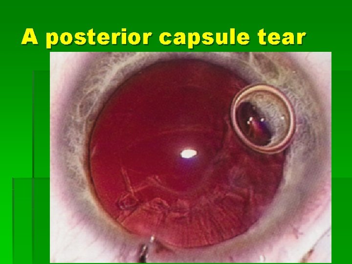 A posterior capsule tear 