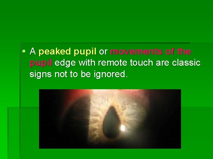 § A peaked pupil or movements of the pupil edge with remote touch are