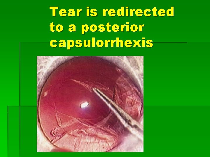 Tear is redirected to a posterior capsulorrhexis 