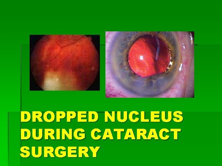 DROPPED NUCLEUS DURING CATARACT SURGERY 