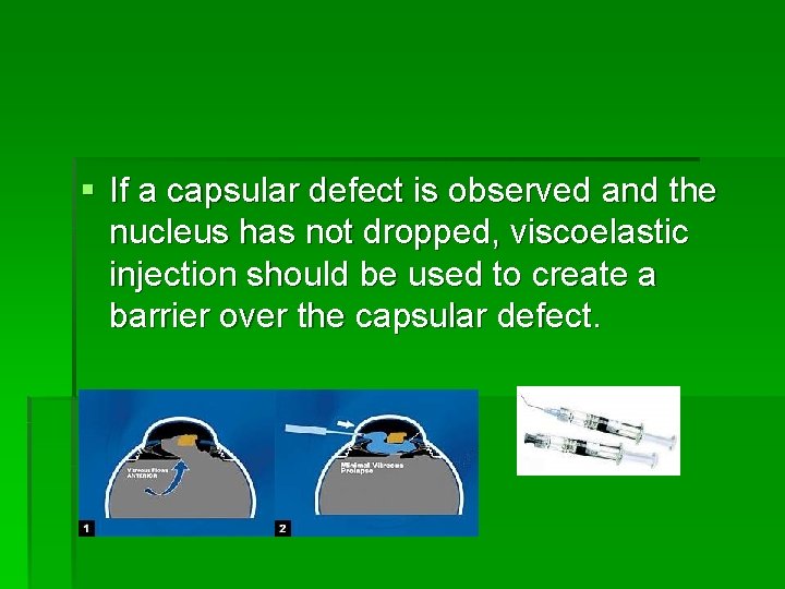 § If a capsular defect is observed and the nucleus has not dropped, viscoelastic