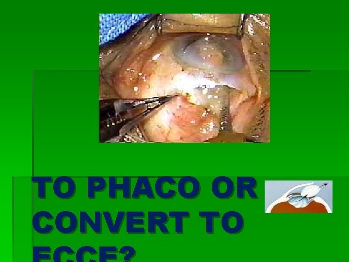 TO PHACO OR CONVERT TO 