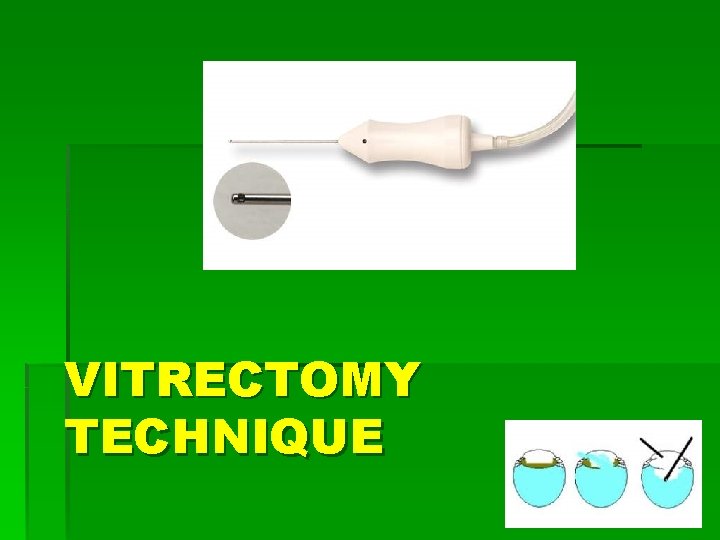 VITRECTOMY TECHNIQUE 