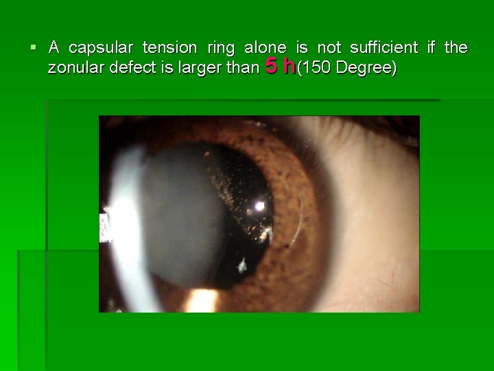 § A capsular tension ring alone is not sufficient if the zonular defect is