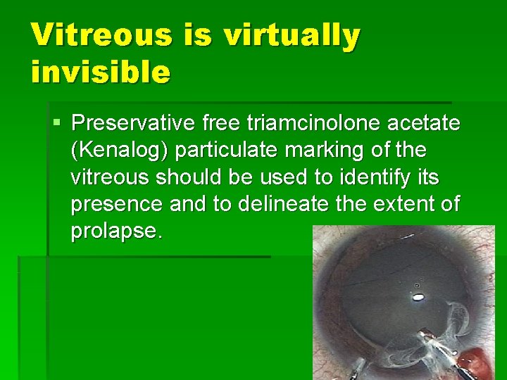 Vitreous is virtually invisible § Preservative free triamcinolone acetate (Kenalog) particulate marking of the