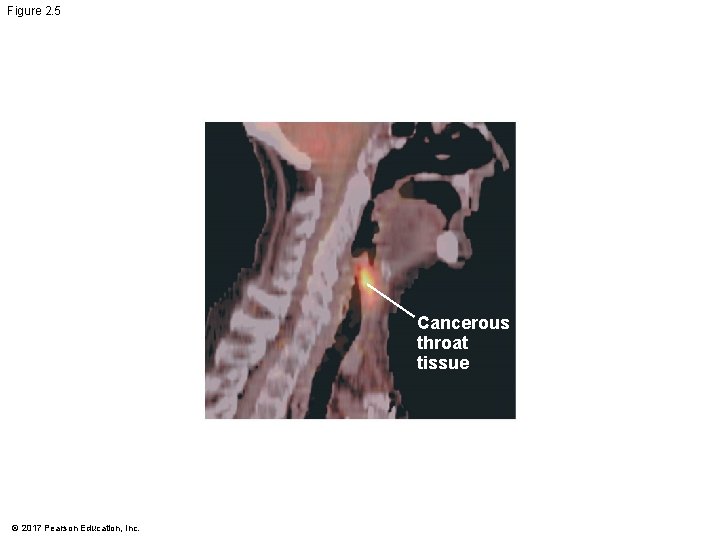 Figure 2. 5 Cancerous throat tissue © 2017 Pearson Education, Inc. Figure 2. 5 Cancerous throat tissue © 2017 Pearson Education, Inc.