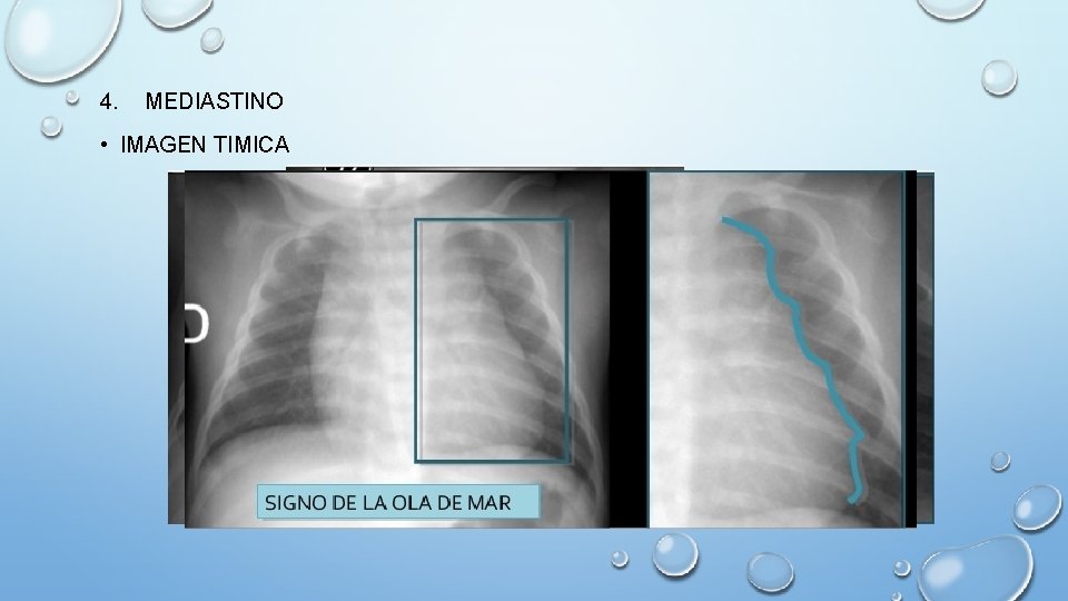 4. MEDIASTINO • IMAGEN TIMICA 