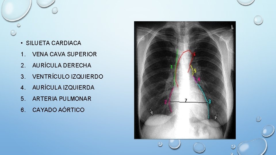  • SILUETA CARDIACA 1. VENA CAVA SUPERIOR 2. AURÍCULA DERECHA 3. VENTRÍCULO IZQUIERDO
