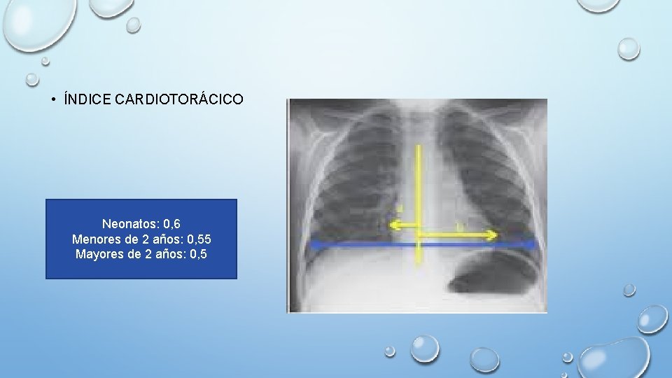 • ÍNDICE CARDIOTORÁCICO Neonatos: 0, 6 Menores de 2 años: 0, 55 Mayores