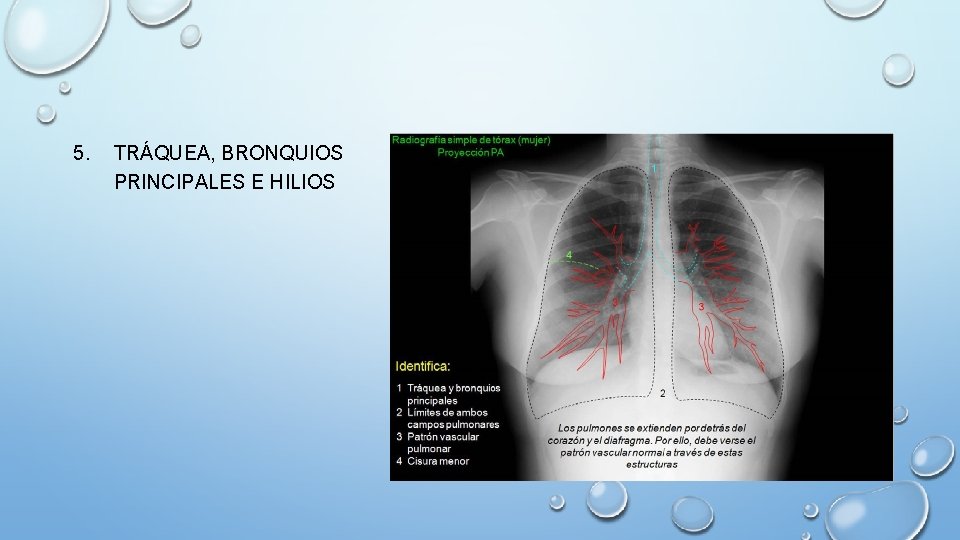 5. TRÁQUEA, BRONQUIOS PRINCIPALES E HILIOS 