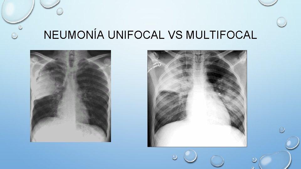 NEUMONÍA UNIFOCAL VS MULTIFOCAL 