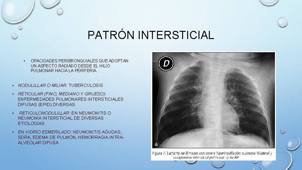 PATRÓN INTERSTICIAL • OPACIDADES PERIBRONQUIALES QUE ADOPTAN UN ASPECTO RADIADO DESDE EL HILIO PULMONAR