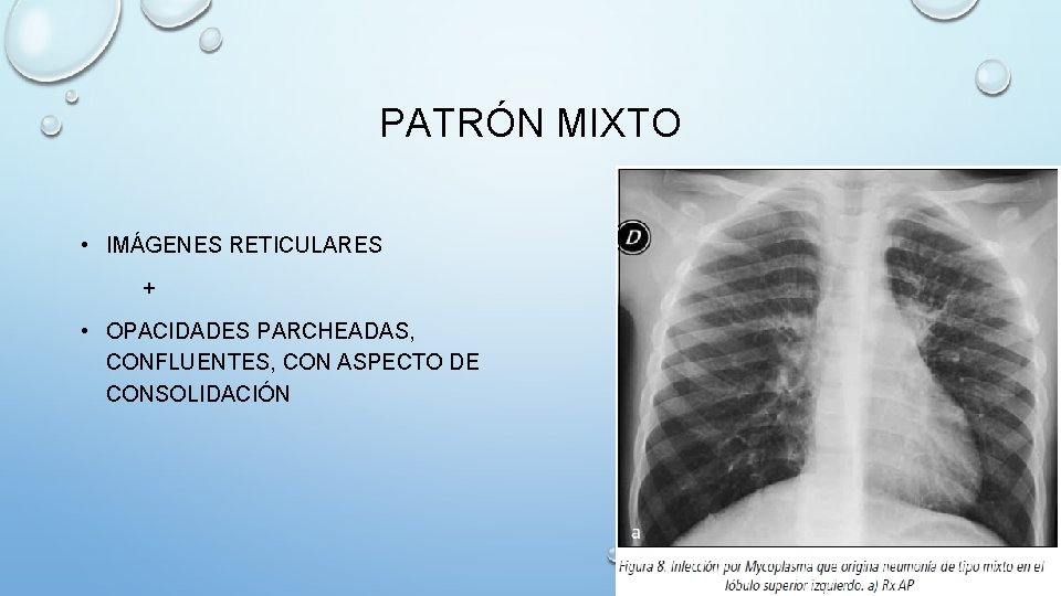 PATRÓN MIXTO • IMÁGENES RETICULARES + • OPACIDADES PARCHEADAS, CONFLUENTES, CON ASPECTO DE CONSOLIDACIÓN