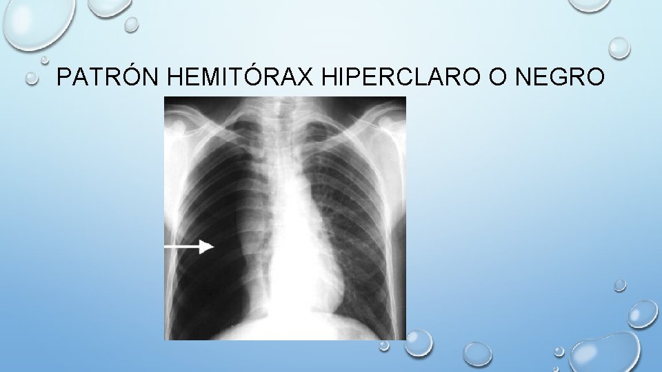 PATRÓN HEMITÓRAX HIPERCLARO O NEGRO 