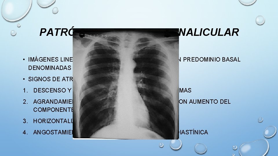 PATRÓN BRONQUIAL O CANALICULAR • IMÁGENES LINEALES HILIOFUGALES PARALELAS CON PREDOMINIO BASAL DENOMINADAS “EN