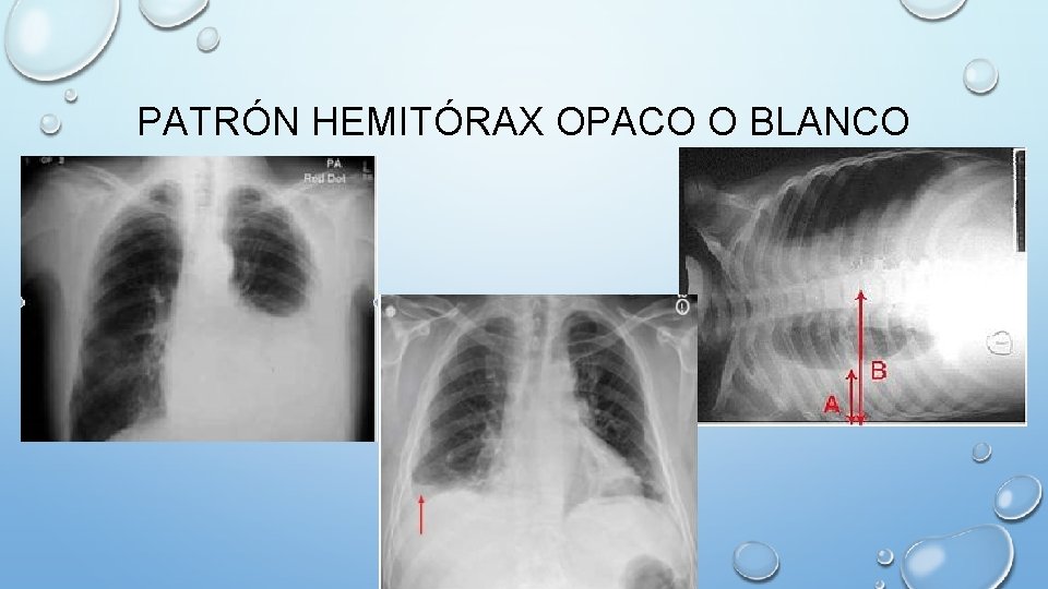 PATRÓN HEMITÓRAX OPACO O BLANCO 