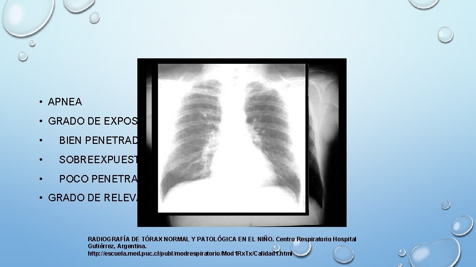  • APNEA • GRADO DE EXPOSICIÓN O PENETRACIÓN • BIEN PENETRADA: CUERPOS VERTEBRALES