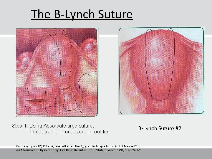 The B-Lynch Suture Step 1: Using Absorbale arge suture. In-out-over…In-out-tie B-Lynch Suture #2 Courtesy: The B-Lynch Suture Step 1: Using Absorbale arge suture. In-out-over…In-out-tie B-Lynch Suture #2 Courtesy: