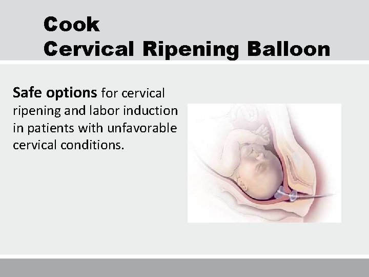 Cook Cervical Ripening Balloon Safe options for cervical ripening and labor induction in patients Cook Cervical Ripening Balloon Safe options for cervical ripening and labor induction in patients