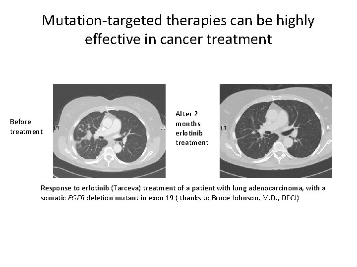 Mutation-targeted therapies can be highly effective in cancer treatment Before treatment After 2 months
