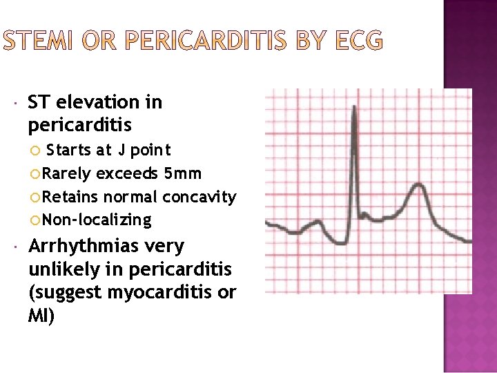 ST elevation in pericarditis Starts at J point Rarely exceeds 5 mm Retains ST elevation in pericarditis Starts at J point Rarely exceeds 5 mm Retains
