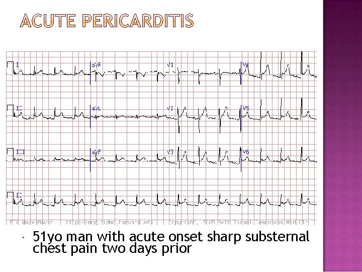 51 yo man with acute onset sharp substernal chest pain two days prior 51 yo man with acute onset sharp substernal chest pain two days prior