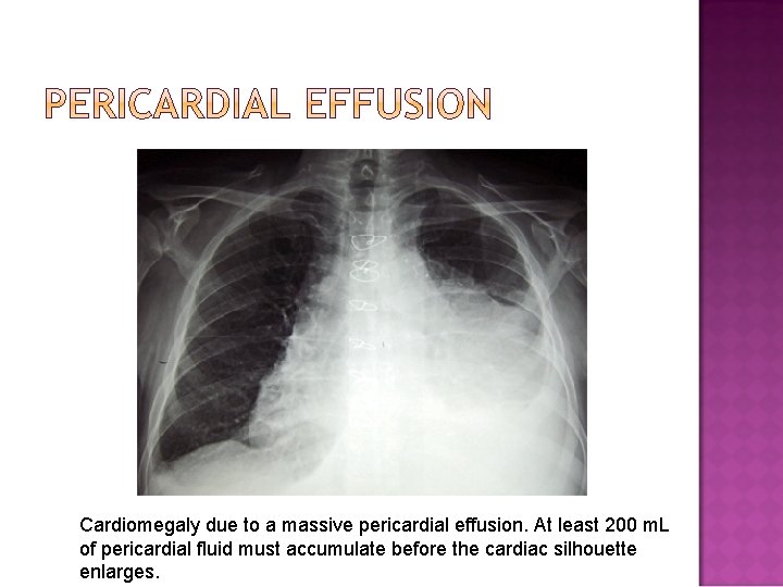 Cardiomegaly due to a massive pericardial effusion. At least 200 m. L of pericardial Cardiomegaly due to a massive pericardial effusion. At least 200 m. L of pericardial