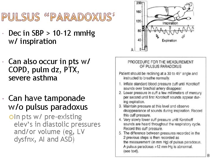 Dec in SBP > 10 -12 mm. Hg w/ inspiration Can also occur Dec in SBP > 10 -12 mm. Hg w/ inspiration Can also occur