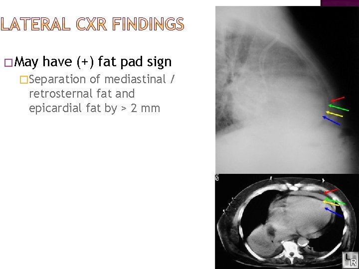 �May have (+) fat pad sign �Separation of mediastinal / retrosternal fat and epicardial �May have (+) fat pad sign �Separation of mediastinal / retrosternal fat and epicardial