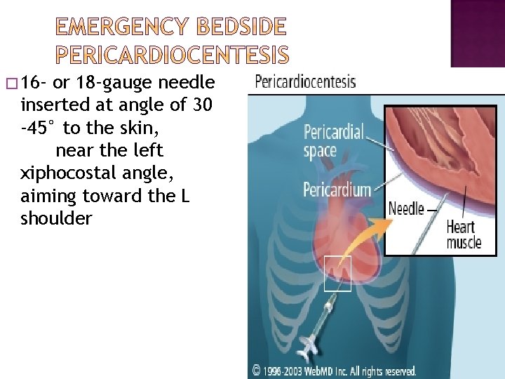 � 16 - or 18 -gauge needle inserted at angle of 30 -45° to � 16 - or 18 -gauge needle inserted at angle of 30 -45° to