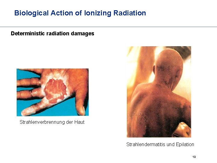 Biological Action of Ionizing Radiation Deterministic radiation damages Strahlenverbrennung der Haut Strahlendermatitis und Epilation