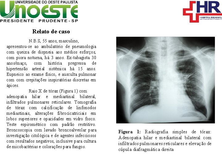 Relato de caso N. B. S, 55 anos, masculino, apresentou-se ao ambulatório de pneumologia