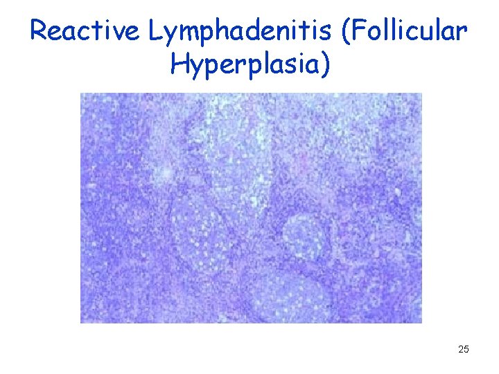 Reactive Lymphadenitis (Follicular Hyperplasia) 25 