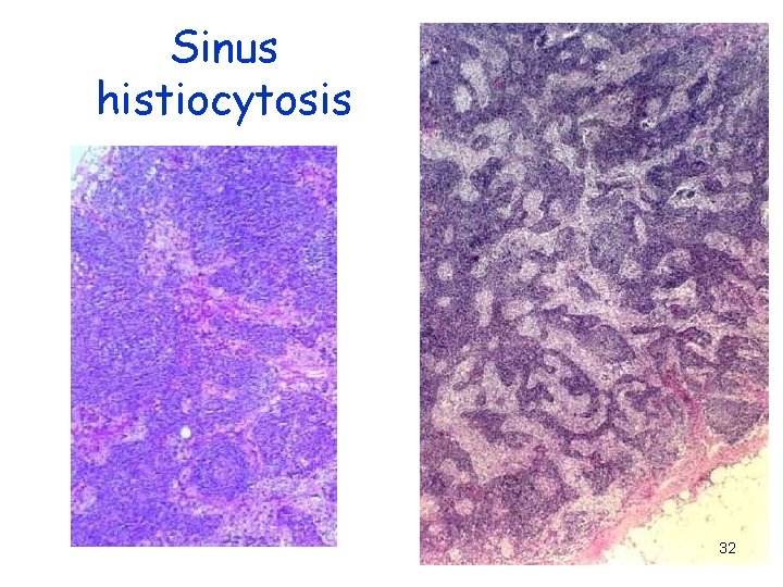 Sinus histiocytosis 32 