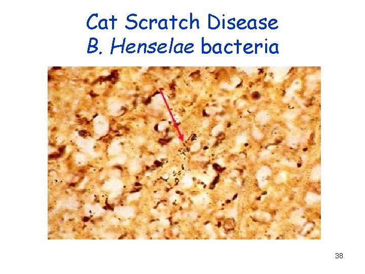 Cat Scratch Disease B. Henselae bacteria 38 